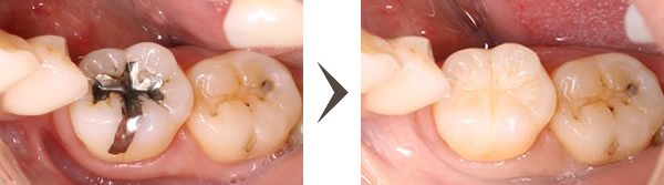 臼歯部の審美歯科治療
