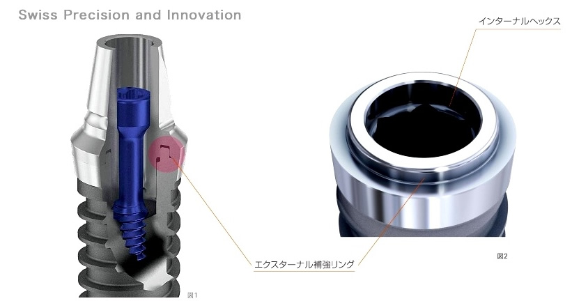 ストローマンインプラント