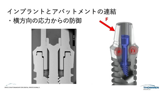 ストローマンインプラント