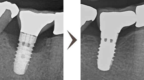 インプラント周囲炎