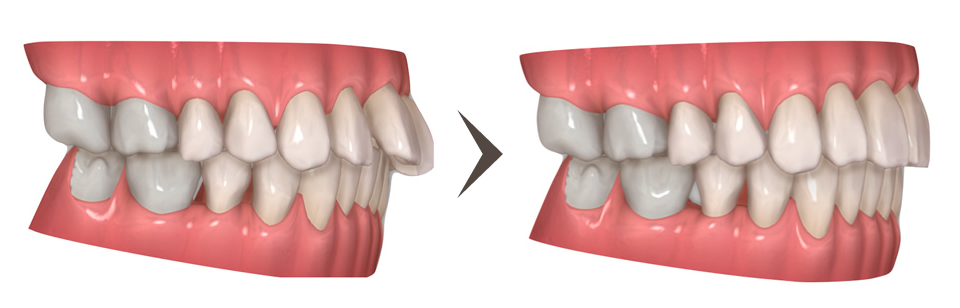 出っ歯（上顎前突）の矯正治療