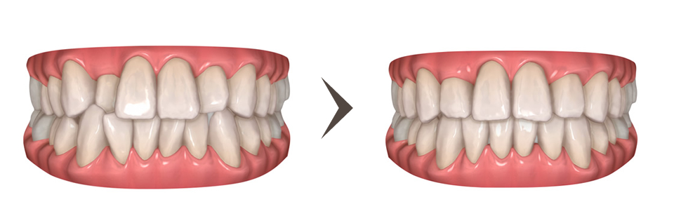 でこぼこの歯並び（叢生）の矯正治療