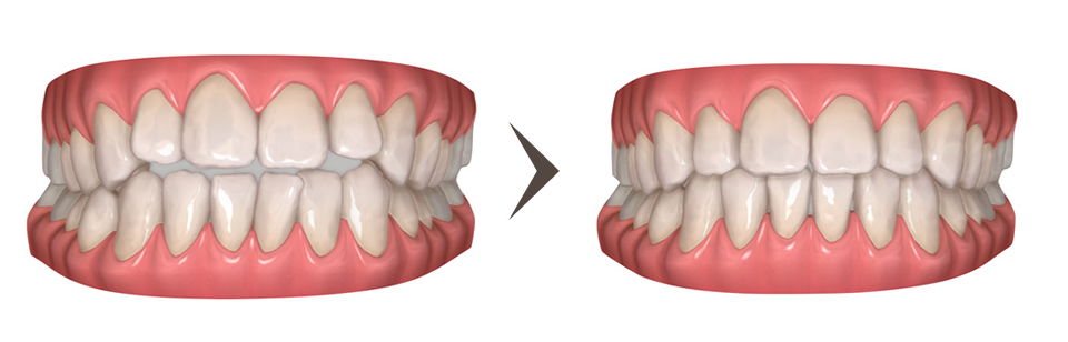 前歯部開咬（オープンバイト）の矯正治療