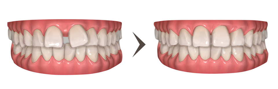 すきっ歯（空隙）の矯正治療